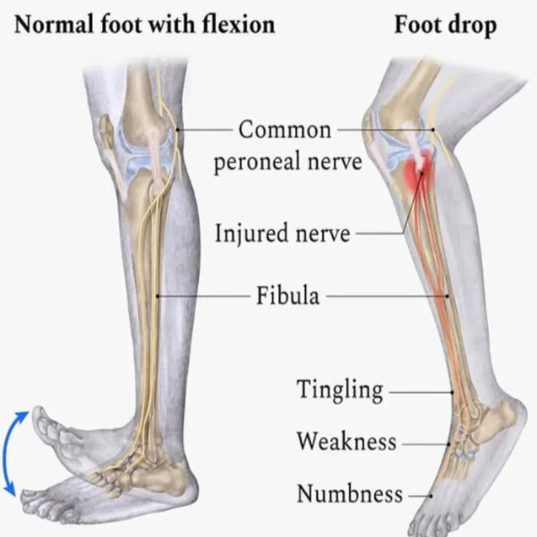 StepLift - Foot Drop Support Brace